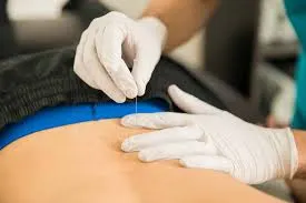 Dry needling treatment on a patient’s back